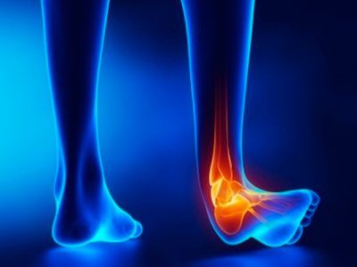 Claves para la recuperación de un esguince: