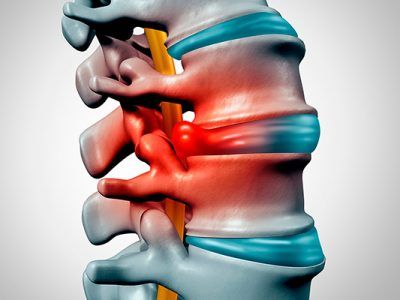 Fisioterapia/tratamiento de una hernia discal